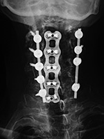 Anterior and posterior cervical fusion with bone struts